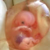 Aborted Fetus