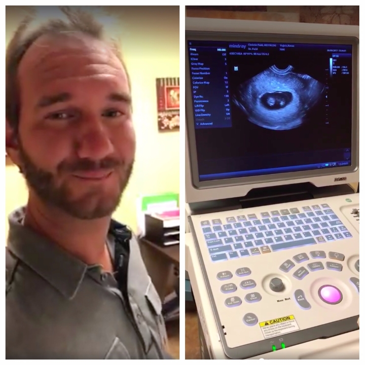 June 20, 2017: Famous evangelist Nick Vujicic, who was born without arms and legs, has hinted that he and his wife, Kanae Miyahara, are expecting twins.