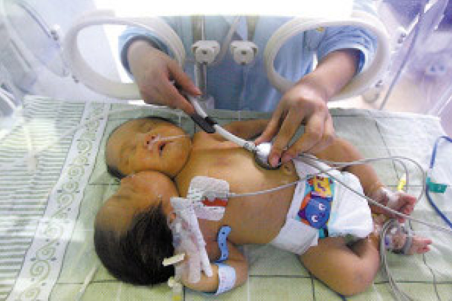 創世電視同工赴四川 領雙頭嬰一家信主