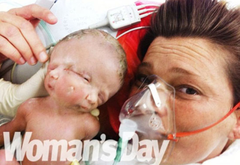 诞「信」和「望」 连体婴母亲感谢上帝礼物