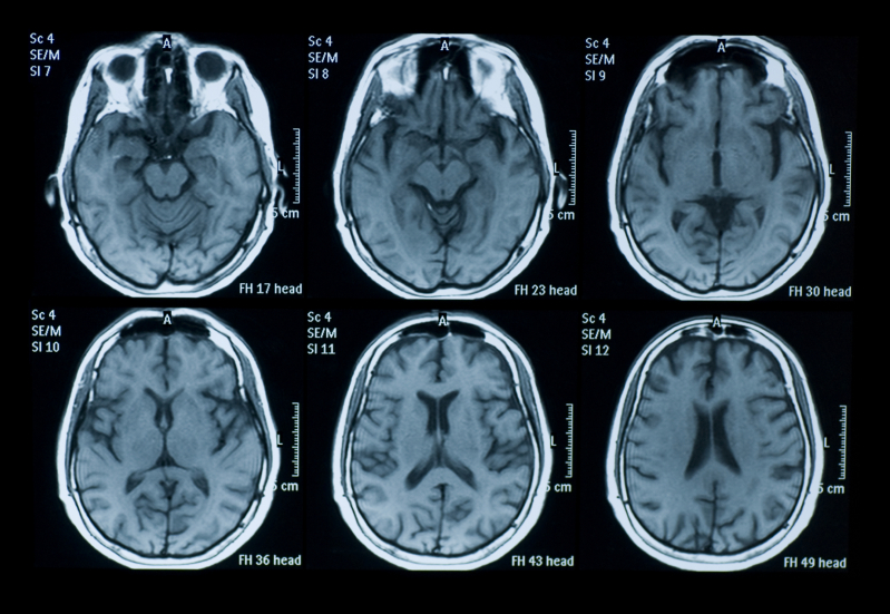 brain scans