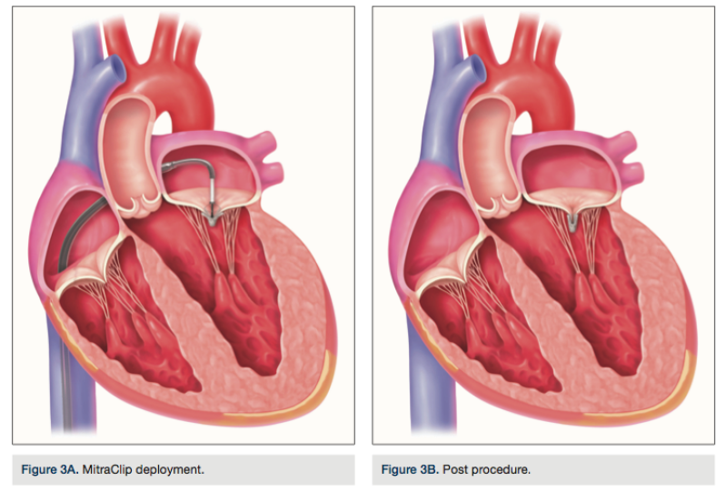mitral valve replacement