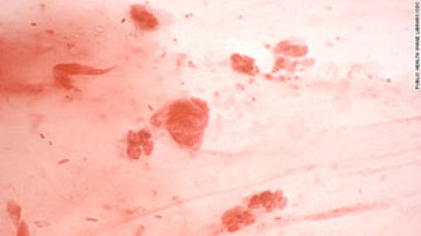 世衛組織：淋病超強耐藥性或成重大危機