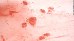 世衛組織：淋病超強耐藥性或成重大危機