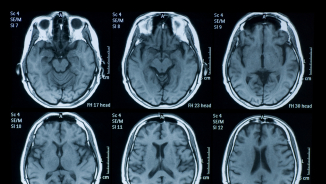 Brain Scans Can Now Predict Patients at Risk of Major Depression, Scientists Say 